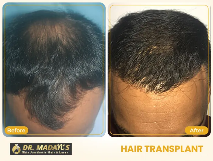 Hair transplant before and after result 2 at Dr Madan Aesthetics